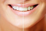 Teeth 20Whitening 201
