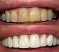 teeth 20whitening 203